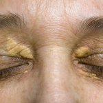 Gejala Xanthelasma dan Cara Mengatasinya. Foto: Ist