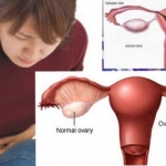 Kenali Gejala dan Bahaya Kista Ovarium Bagi Wanita. Foto: Ist