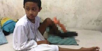 Patah Tulang, Operasi Dua Kali di RS Saiful Anwar, Kaki Bocah ini Membusuk