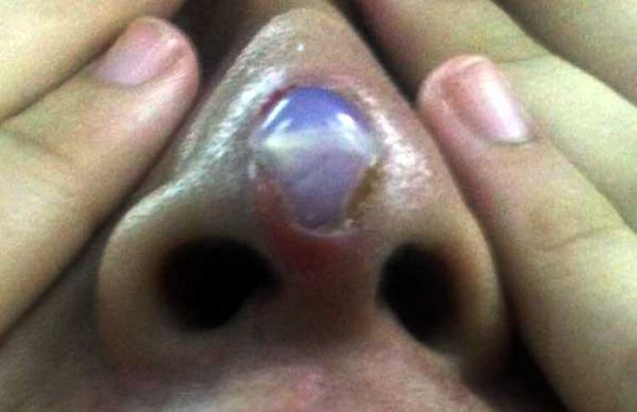 Operasi Plastik di Hidung, Lha Kok Plastiknya yang  Malah Nongol