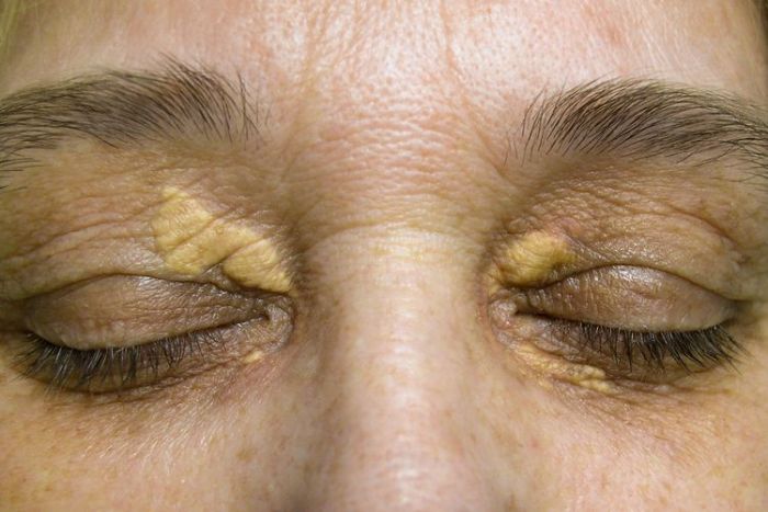 Gejala Xanthelasma dan Cara Mengatasinya