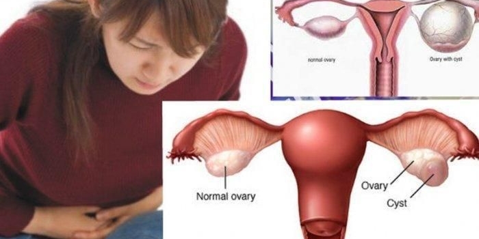 kenali-gejala-dan-bahaya-kista-ovarium-bagi-wanita