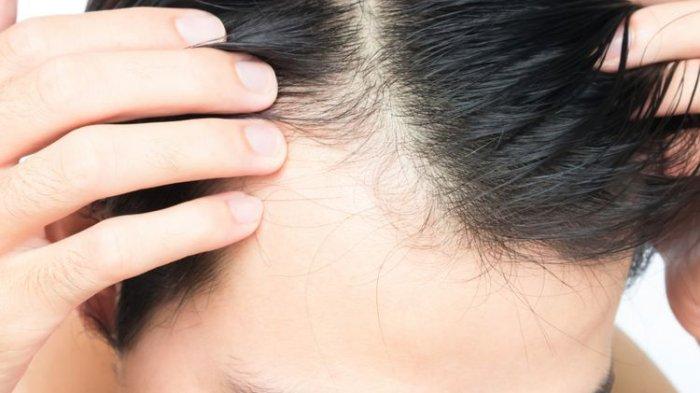 Kekurangan 7 Vitamin Ini Dapat Menyebabkan Kebotakan, Simak Penjelasannya. Foto: Ist
