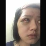 Wajah dan mata Dita Aditia Ismawati lebam. Foto: detik.com