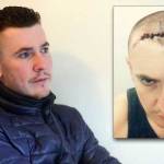 Daniel Staples dengan bekas luka operasi pengangkatan kanker otak. foto: repro mirror.co.uk