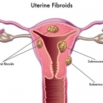 Fibroid Rahim.