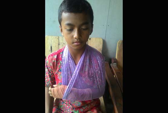 Edy Purwanto, siswa kelas V, SDN Tanjung Lor yang cidera tangan saat latihan.