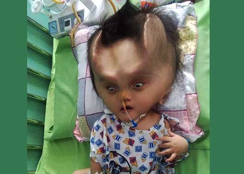 Usai Dioperasi, Bayi ini Tumbuh 