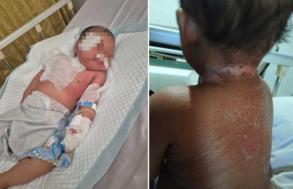 Alergi Parah hingga Kulit Melepuh, Bayi di Tuban tak Dapat Penanganan Maksimal dari RSUD dr. Koesma