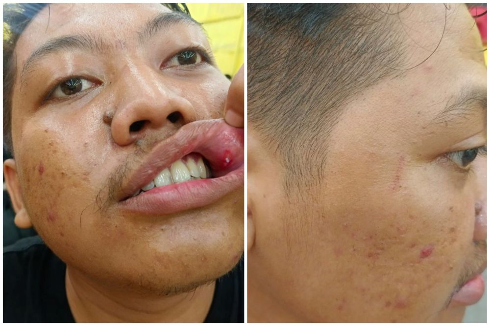 Kondisi Rama usai diduga dianiaya saat melakukan peliputan