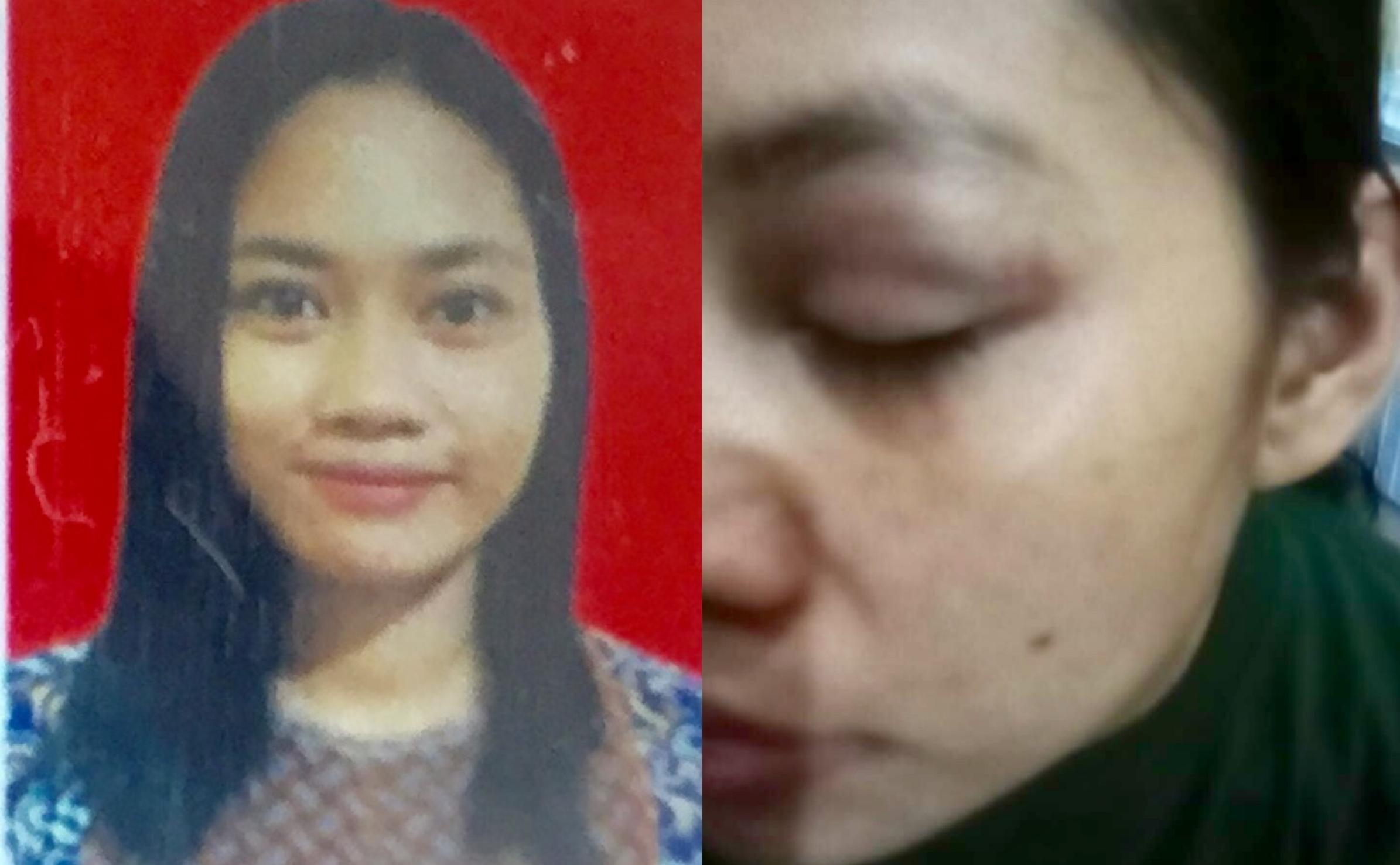 Luka lebam di wajah Lusi Febrianti yang diduga jadi korban penganiayaan