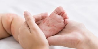 Mengkhawatirkan! Dinkes Pamekasan Catat Kasus Campak per September Melonjak, 17 Desa Dinyatakan KLB