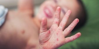 Belum Sepekan, Dua Balita di Pamekasan Terduga Campak Meninggal Dunia, Dinkes Ingatkan Imunisasi