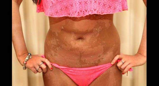 Kalau begini, yang benar apakah, meski melepuh tetap seksi, ataukah, meskipun seksi tapi kan melepuh? Apa pilihan Anda? foto: repro mirror.co.uk