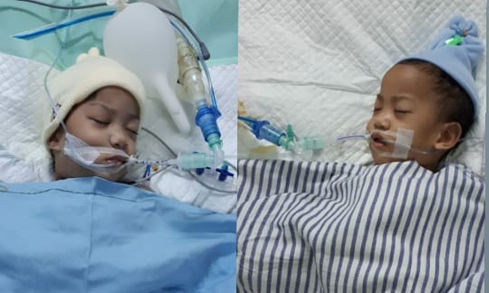 Bayi kembar siam asal Kendari, Sulawesi Tenggara, Aqila dan Azila berhasil dipisahkan oleh tim dokter RSUD dr. Soetomo, Surabaya. foto: istimewa