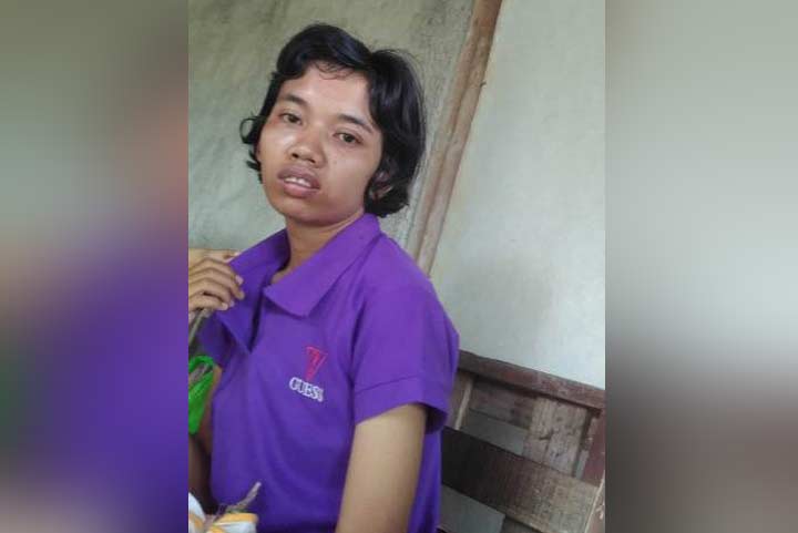 Yuli, gadis penderita epilepsi dan luka bakar yang nunggak BPJS.