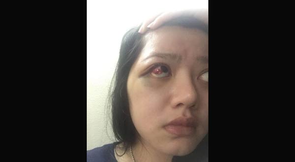 Wajah dan mata Dita Aditia Ismawati lebam. Foto: detik.com