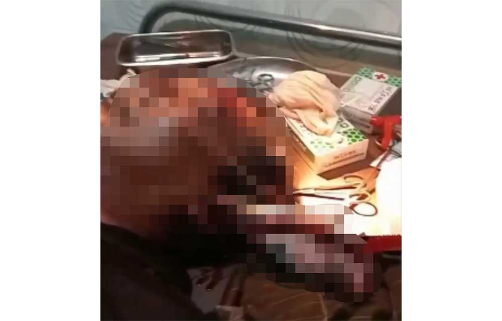 Hendak Cari Ikan, Warga Pamekasan Tertancap Moncong Ikan Marlin di Bagian Telinga