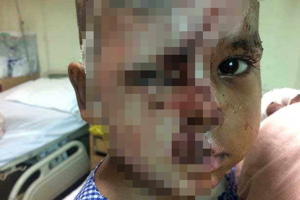 Kondisi Aditya Raj dengan luka bakar 20 persen. Tega nian. foto: repro mirror.co.uk