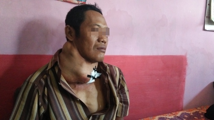 BUTUH ULURAN TANGAN: Kondisi tumor Sukadi yang semakin parah. Tampak luka-lukanya yang hanya ditutupi dengan plester seadanya. Foto: RONY S/BANGSAONLINE