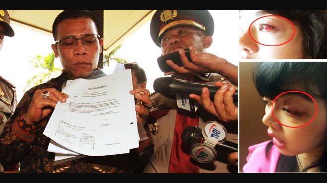 Masinton Pasaribu memiliki kronologi kasus pemukulan terhadap Dita menurut versinya. Tampak Dita dengan mata lebam lantaran diduga dipukul Masinton. foto: ehijrah.com