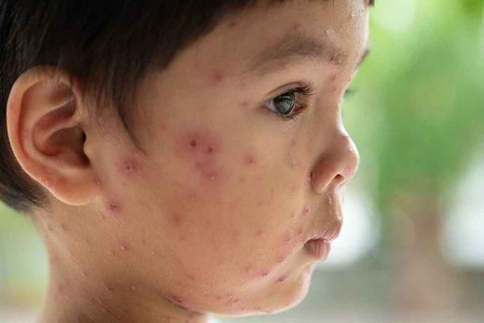 Virus varicela-zoster, ¿la causa de la varicela?  Síntomas, Riesgos y Tratamiento |  BANGSAONLINE.com – Últimas noticias