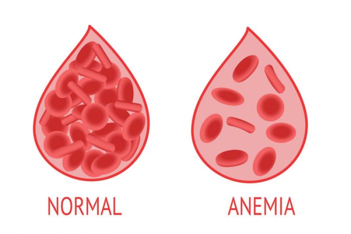 Tips Mencegah Anemia Pada Remaja