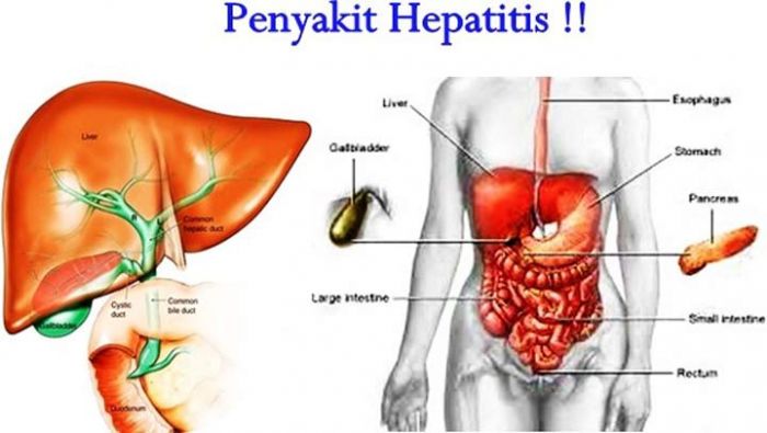 Dinkes Pacitan Belum Tetapkan KLB atas Serangan Hepatitis A di Kecamatan Ngadirojo dan Sudimoro