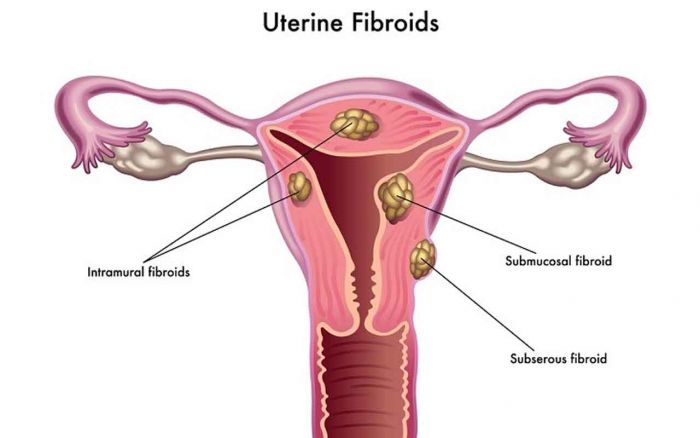 Sarkoma Uterus: Pengertian, Penyebab, dan Penanggulangan