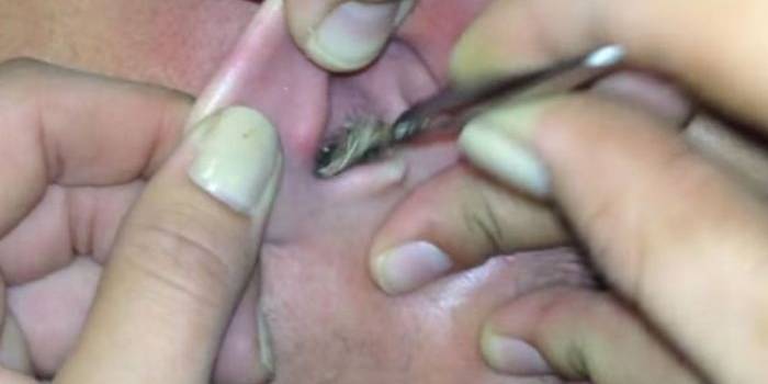 ?

Dengan menggunakan pinset, ngengat yang sudah bersarang selama tiga hari di telinga ini berhasil dikeluarkan. Foto: repro dailymirror