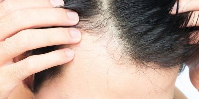 Kekurangan 7 Vitamin Ini Dapat Menyebabkan Kebotakan, Simak Penjelasannya. Foto: Ist