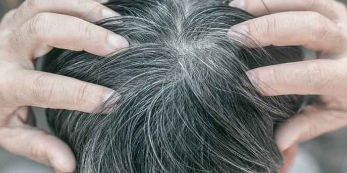 Ilustrasi Beruban. Foto: Alodokter