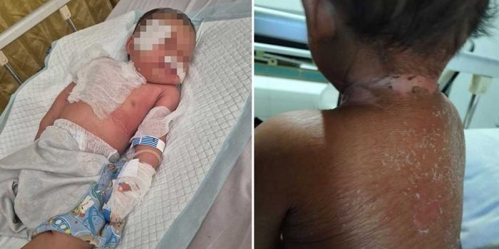alergi-parah-hingga-kulit-melepuh-bayi-di-tuban-tak-dapat-penanganan-maksimal-dari-rsud-dr-koesma