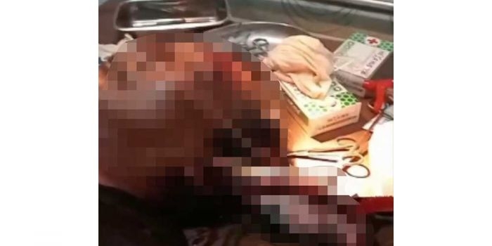 Misnaton (47) saat mendapatkan perawatan akibat tertancap moncong ikan marlin.