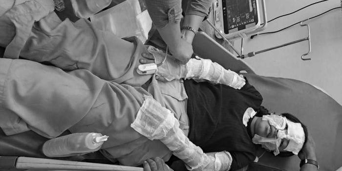Korban ledakan kompor gas portabel di Surabaya.