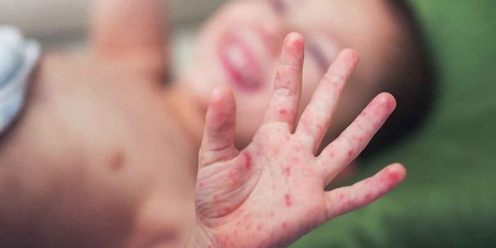 ori-campak-rubela-di-sumenep-capai-553-persen-giligenting-tertinggi-dungkek-terendah