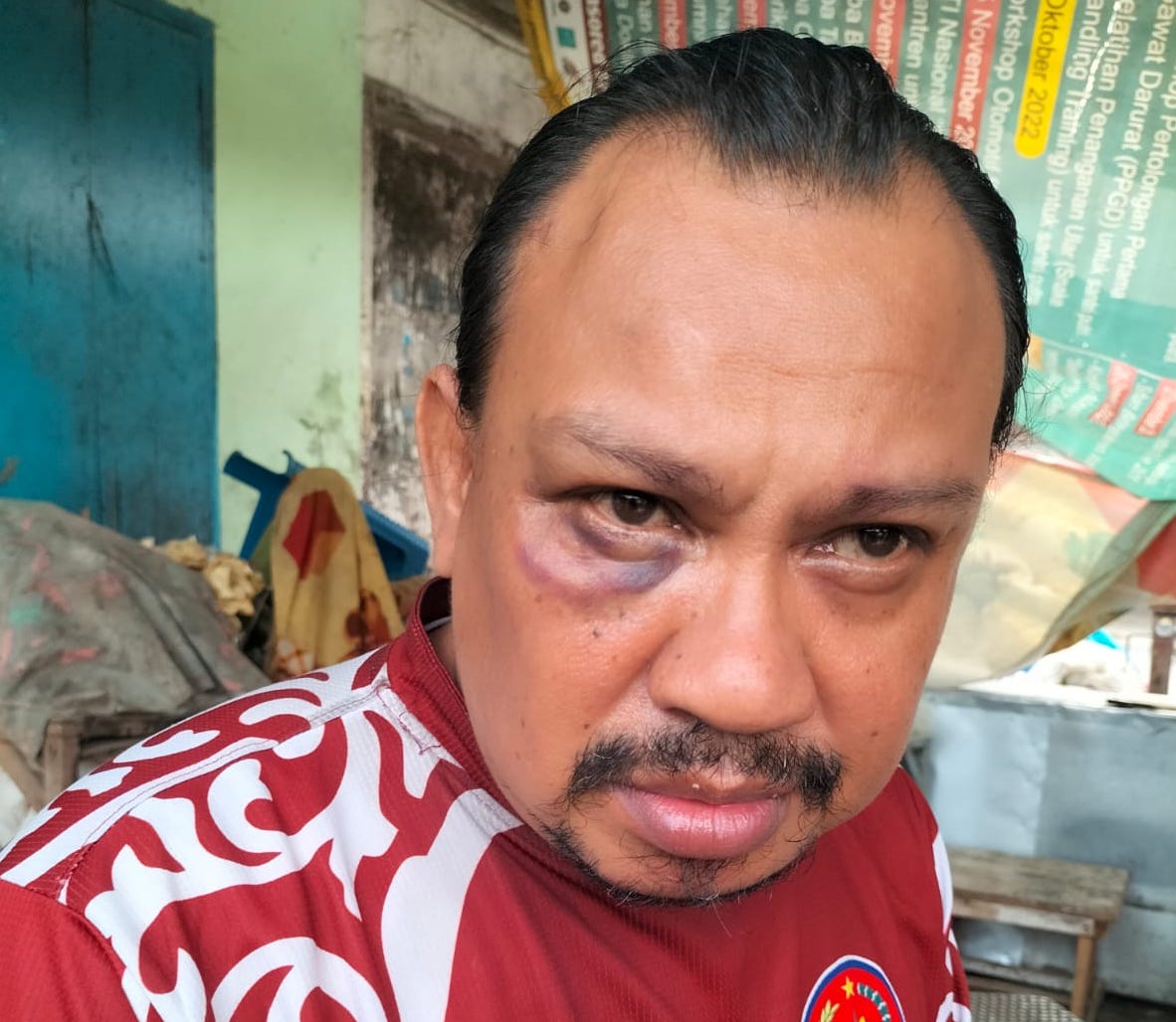 Sijak saat menunjukan luka lebam di matanya yang diduga akibat dipukul oleh AY