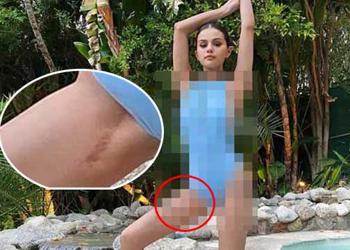 Bekas sayatan operasi yang selama ini disembunyikan. (Image: Selena Gomez/ Instagram)