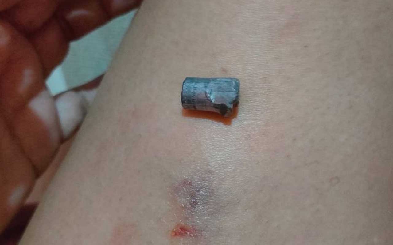 Barang bukti peluru dan kaki korban mengalami memar usai terkena peluru nyasar. Foto: Ist.