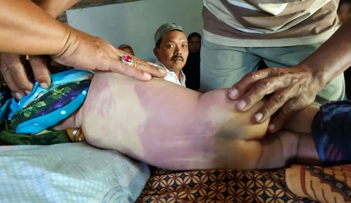 Kondisi jenazah bayi yang punggungnya penuh luka lebam. 