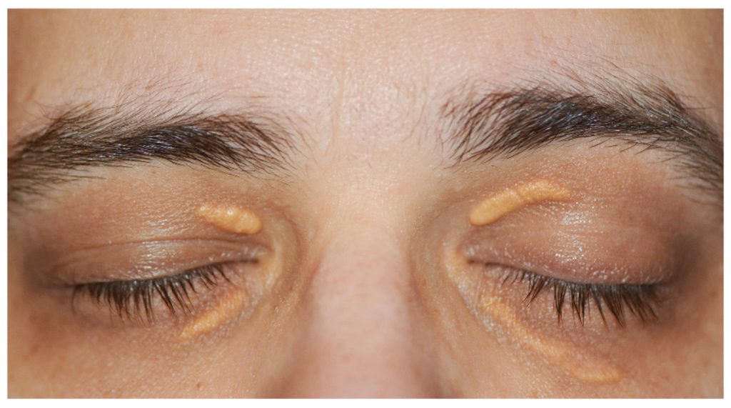 penyebab-munculnya-xanthelasma-bercak-warna-kuning-di-sekitar-mata