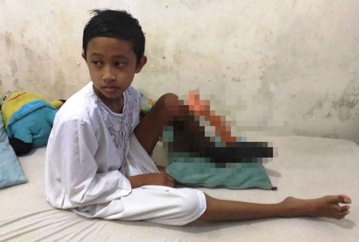 Setyo Aldi dalam perawatan di rumah. Kakinya menghitam dan membusuk.