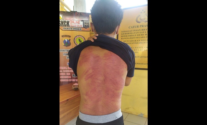 PENUH LUKA: Punggung korban yang penuh luka memar akibat penganiayaan yang dlakukan oleh segerombolan orang ak dikenal.