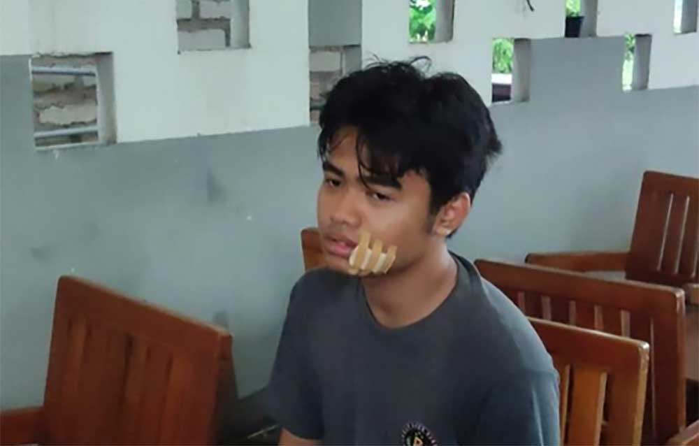 M Bagus Sugiarto (19) mengalami luka di pipinya usai menjadi korban jebakan benang nilon di Suramadu. (dok. Ist)