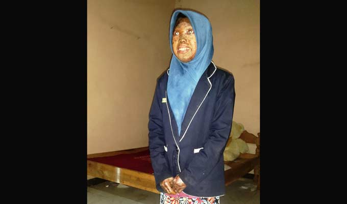 Maya Dwi Wahyu penderita penyakit kulit di sekujur tubuh.